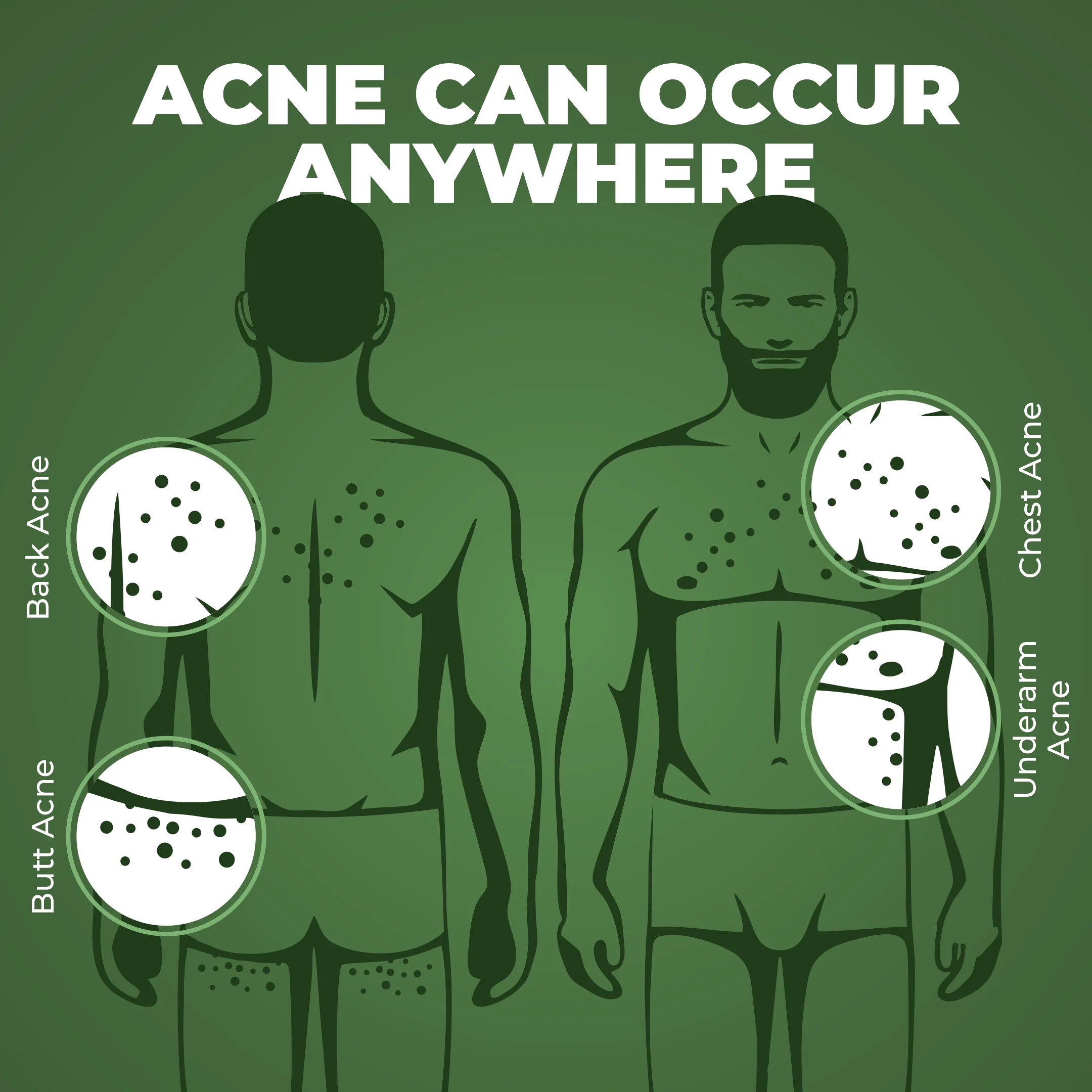Acne Control combo - Image 5